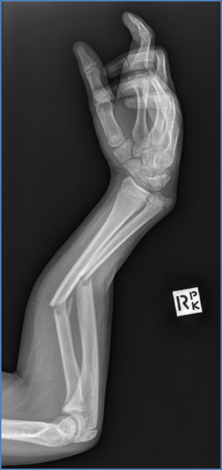Radius & Ulnar Fracture
