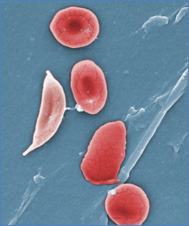 SICKLE CELL ANAEMIA