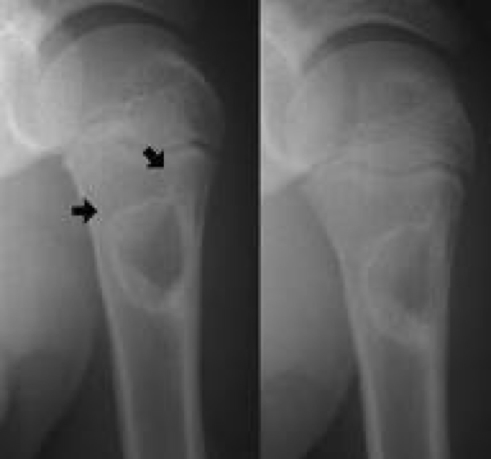 benign bony tumours - SIMPLE BONE CYSTS