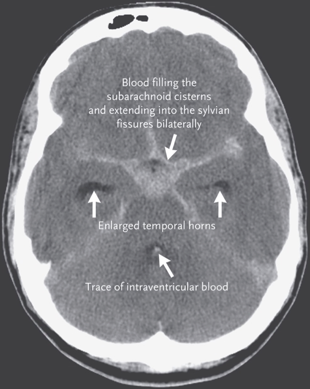 intracranial haemorrhages - SUBARACHNOID