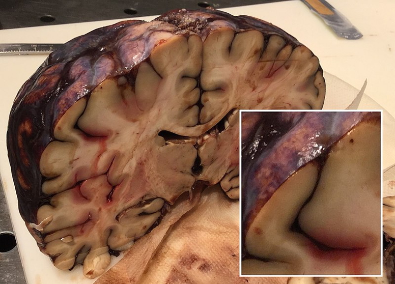 intracranial haemorrhages - SUBARACHNOID