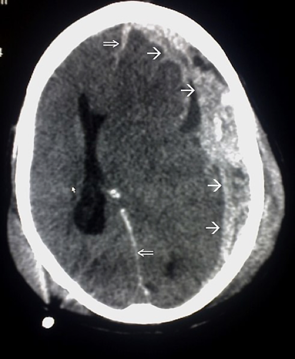 intracranial haemorrhages - SUBDURAL