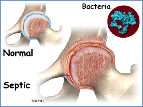 Septic Arthritis