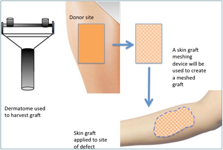 Procedural dermatology - Skin Grafts