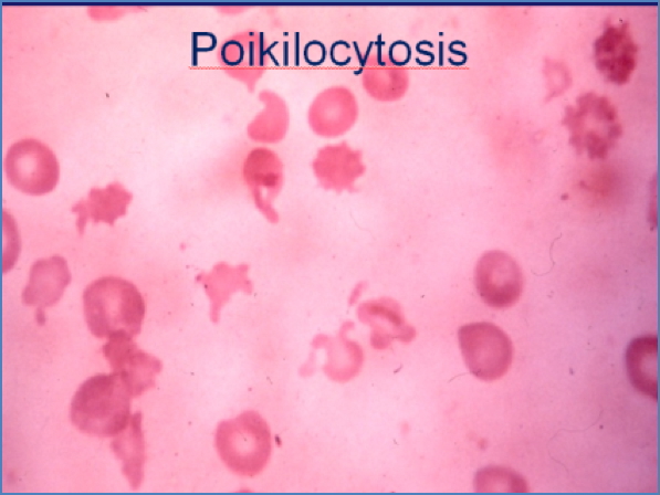 THALASSAEMIAS - microscopy