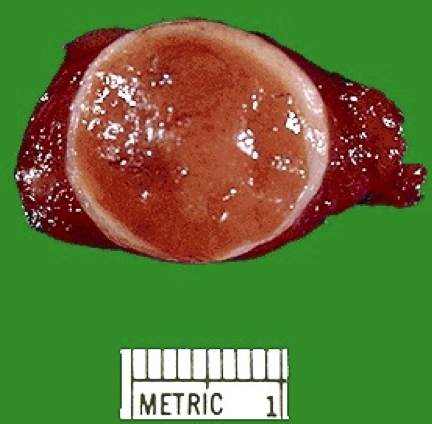 THYROID ADENOMA