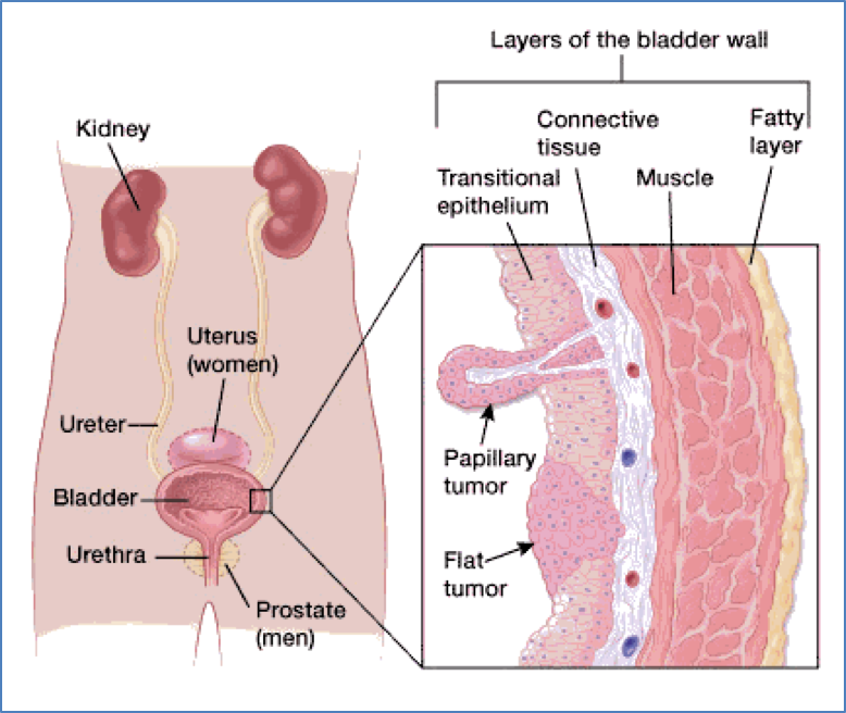 TRANSITIONAL CELL CARCINOMAS
