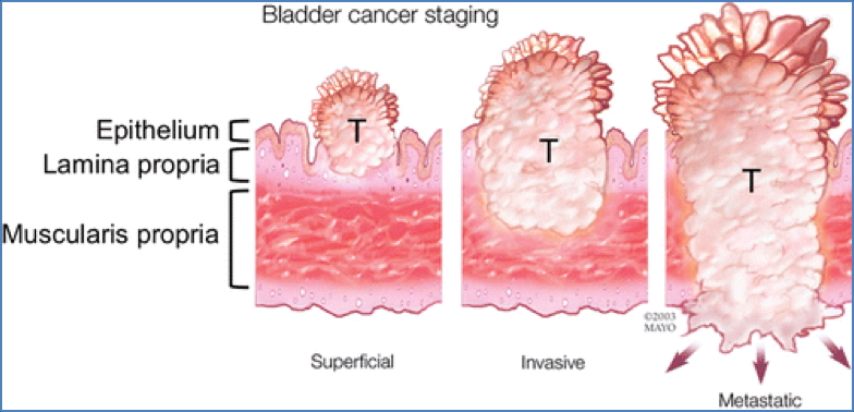 TRANSITIONAL CELL CARCINOMAS