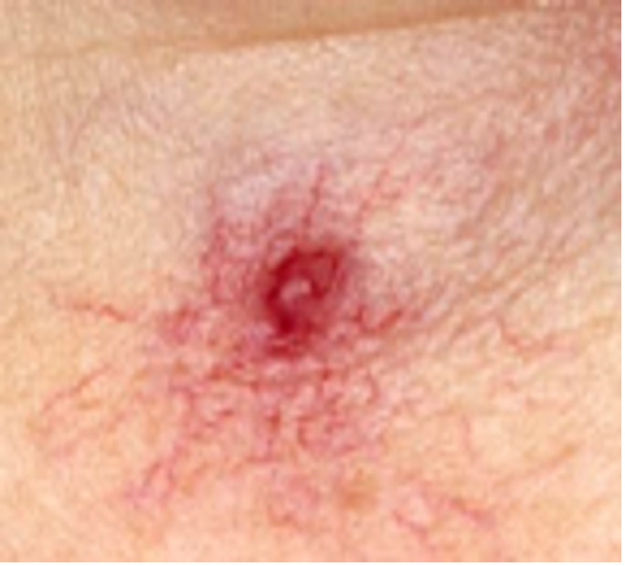 Telangiectasia