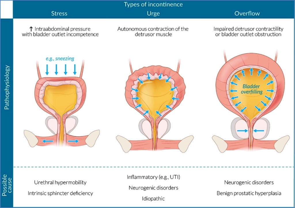 URINARY INCONTINENCE