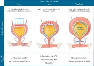 Urinary Incontinence | Renal | MedStudentNotes