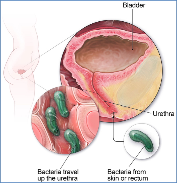 URINARY TRACT INFECTIONS