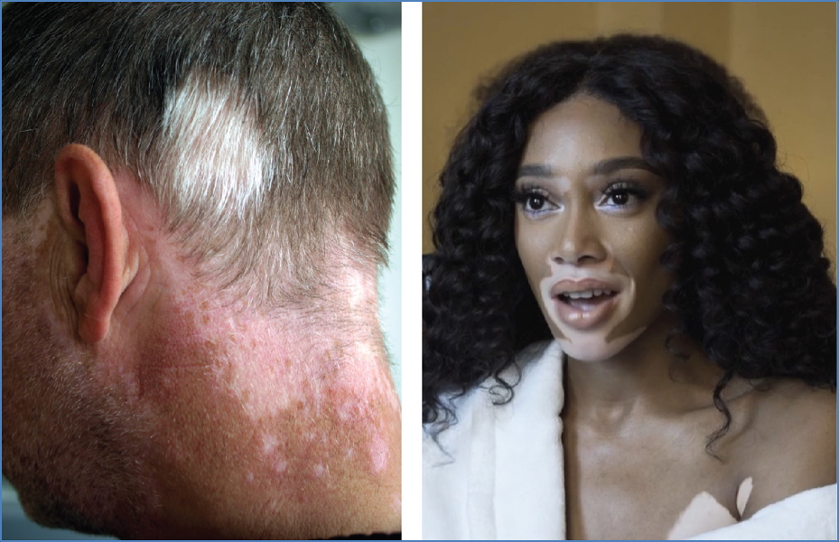 VITILIGO