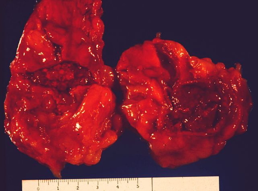 WATERHOUSE-FRIDERICHSEN SYNDROME