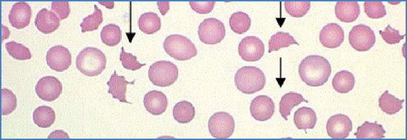 Warm Antibody Autoimmune Haemolytic Anaemia