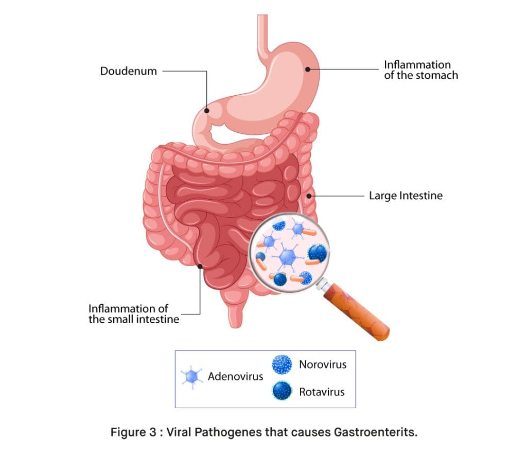 Viral Gastroenteritis