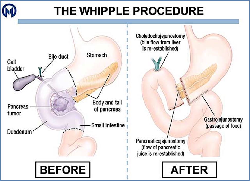Pancreatic Cancer - Whipple Procedure