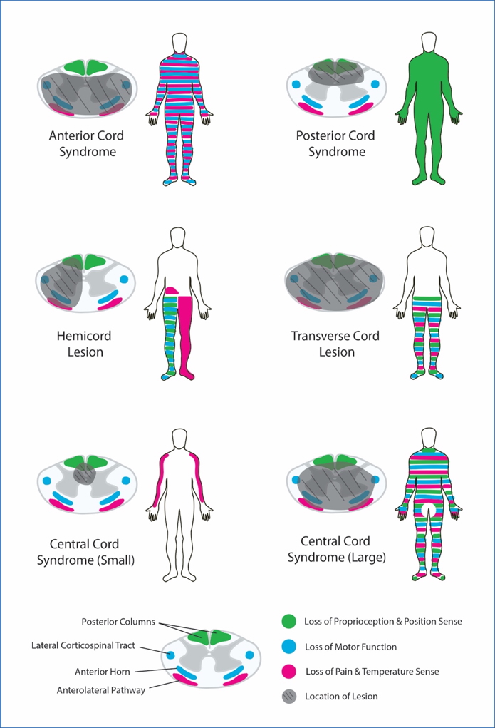 Spinal cord syndromes
