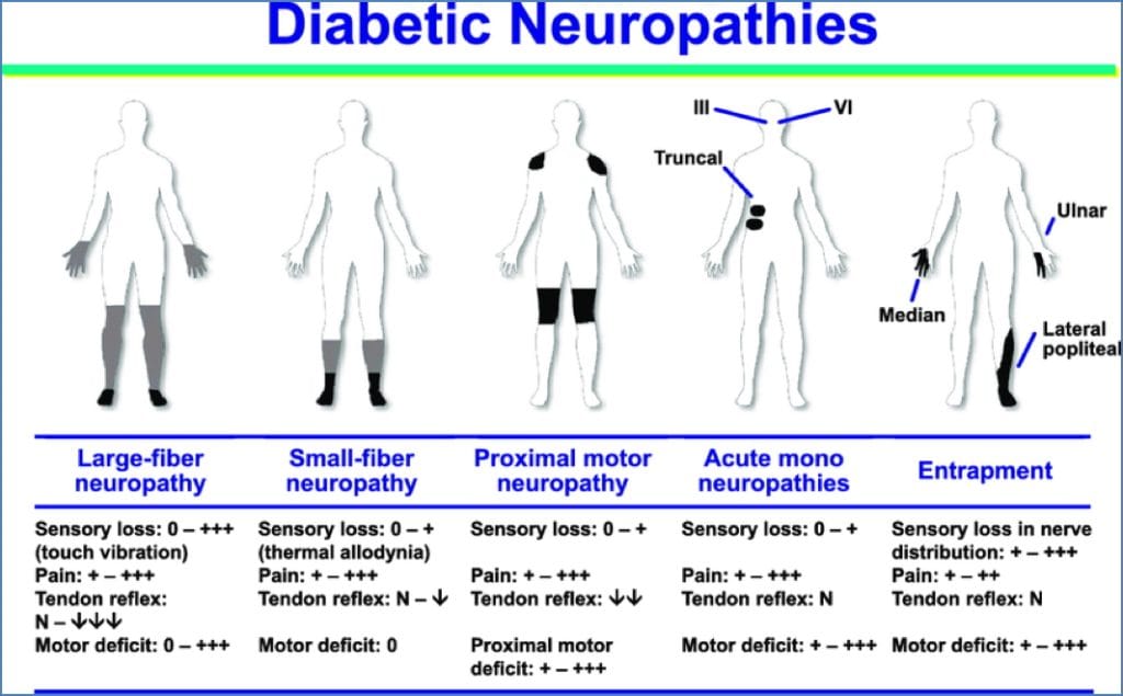 diabetic peripheral neuropathies