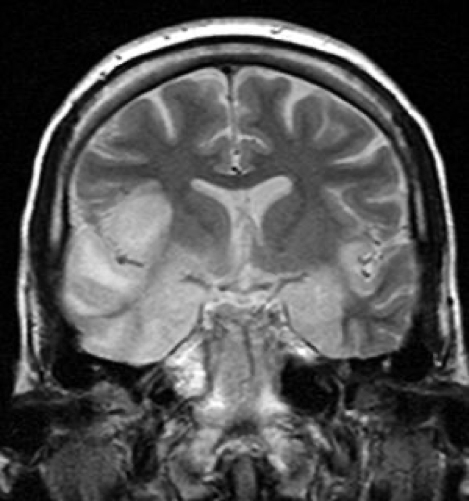 encephalitis MRI