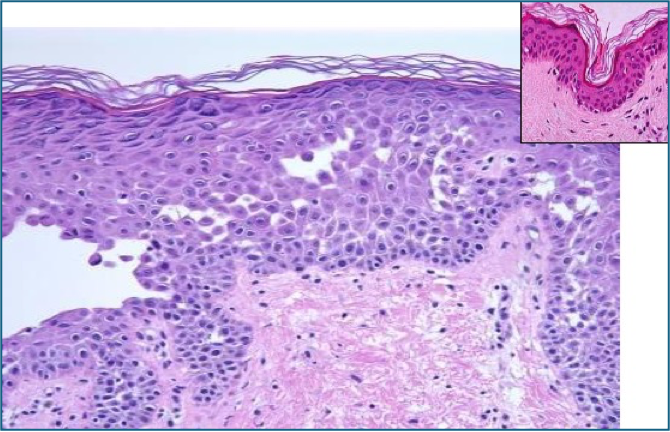 skin histology - Acantholysis