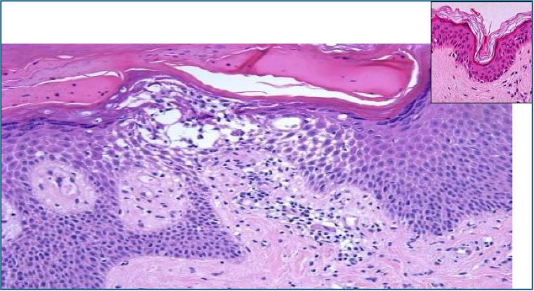 skin histology - Spongiosis
