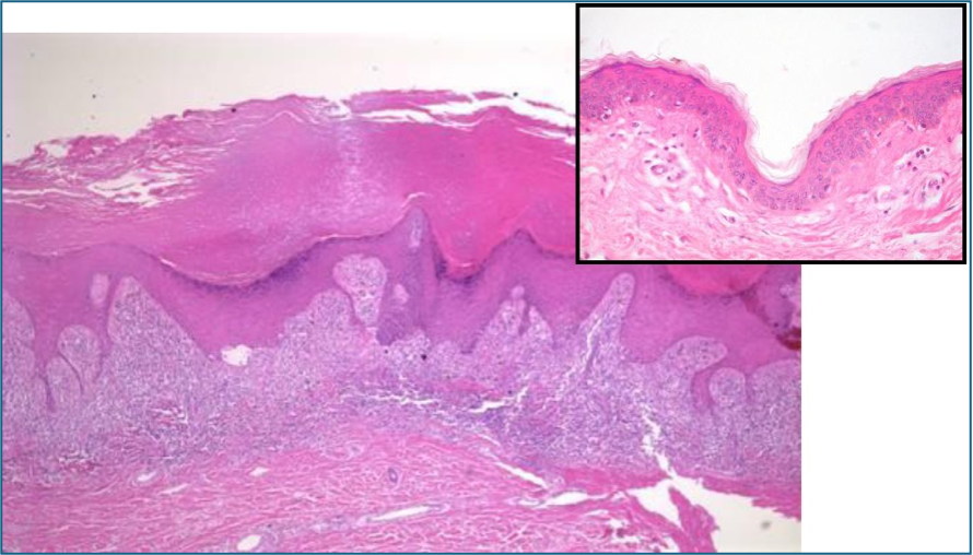 skin histology - Hyperkeratosis