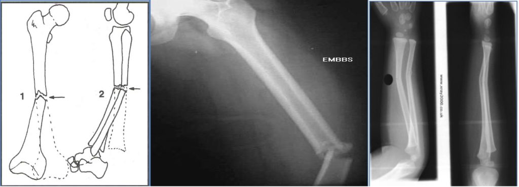 bony injuries - Is the fracture angulated