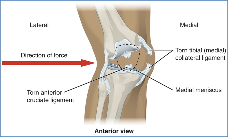 knee ligament injury