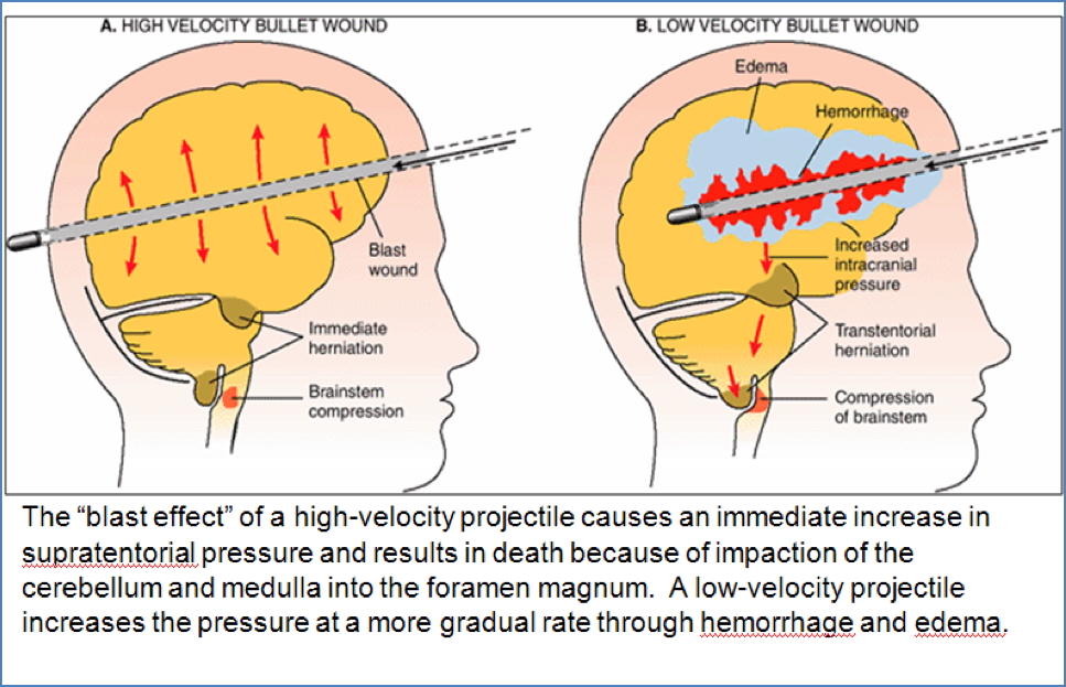 traumatic brain injuries - brain laceration