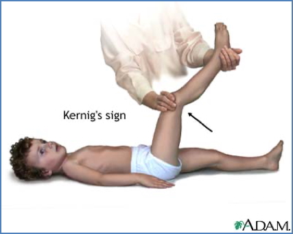 meningitis - kernig's sign