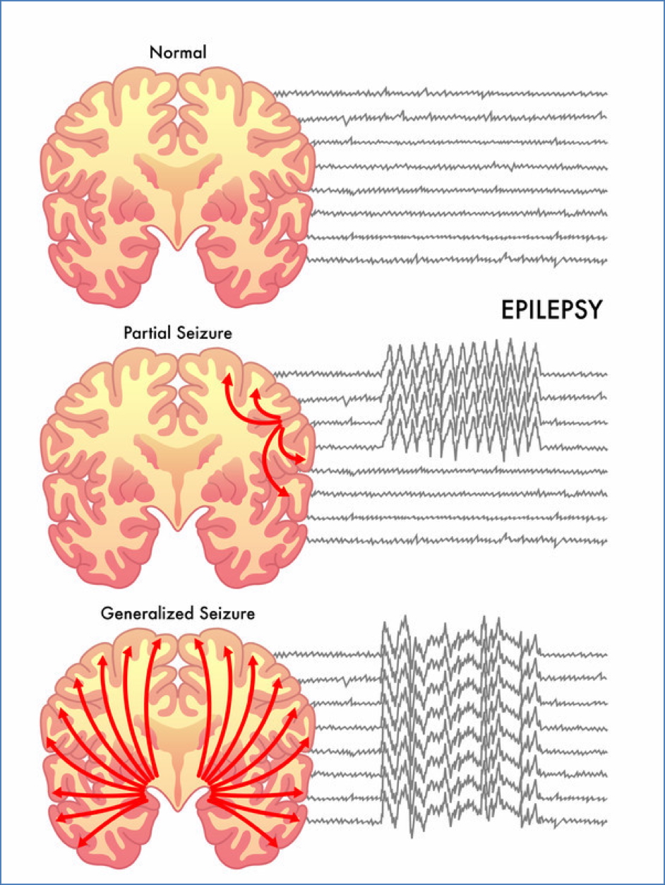 epilepsy seizure types eeg