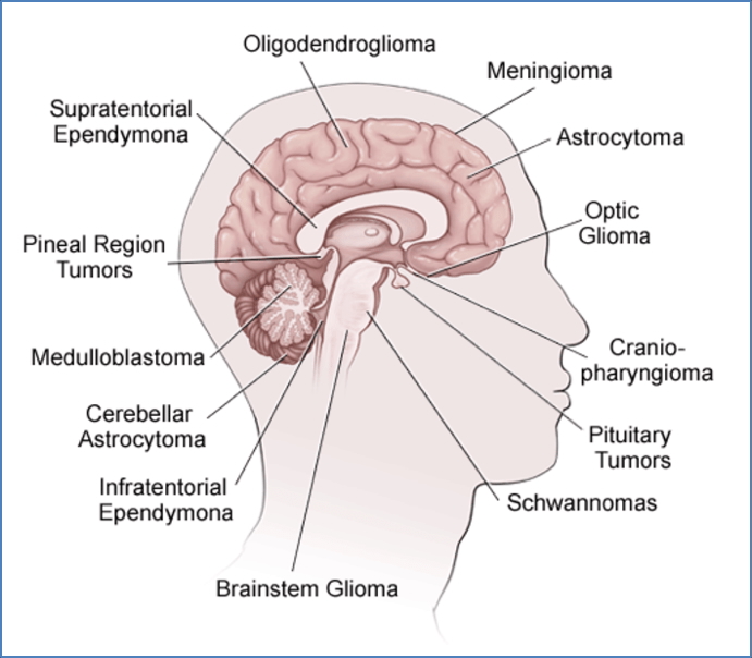 brain tumors and locations
