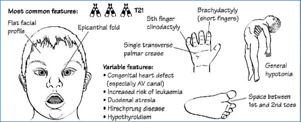 47, XY, +21- DOWN’S SYNDROME