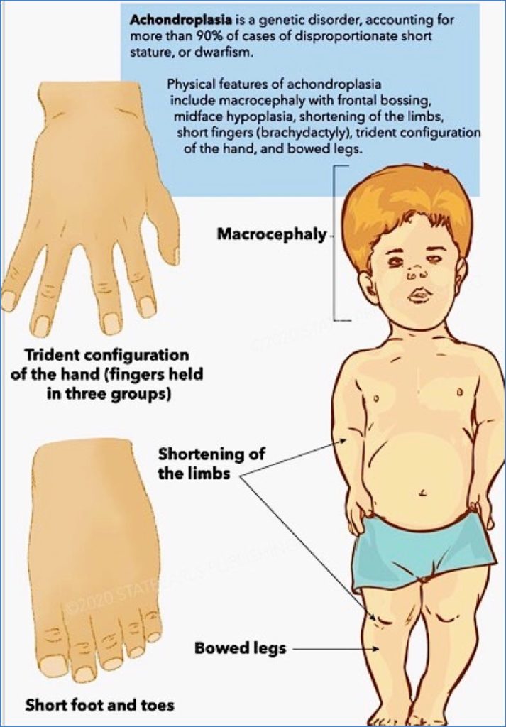 dwarfism genetics: ACHONDROPLASIA