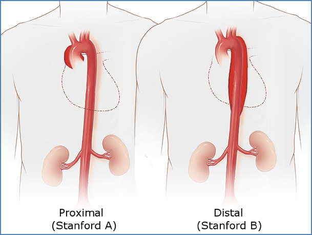 AORTIC DISSECTION