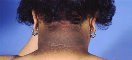 the endocrine examination: Acanthosis Nigricans
