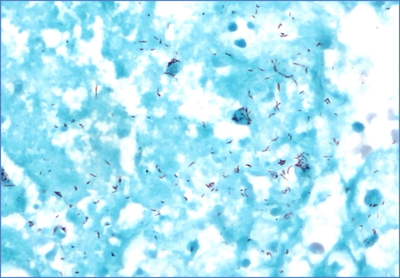 microbiology of bacteria: Acid-Fast Stain