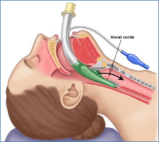 Advanced Interventions