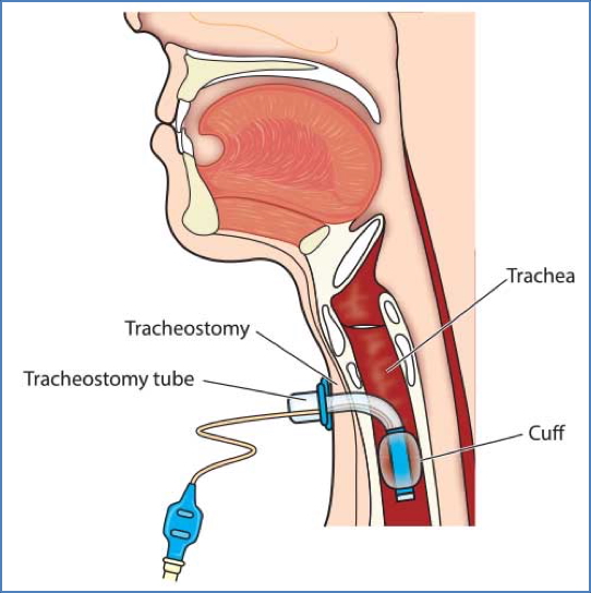 Advanced Interventions