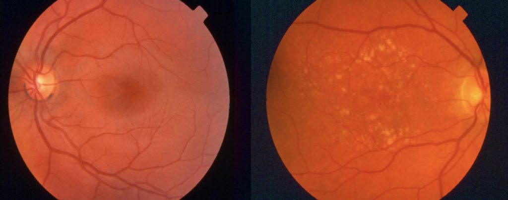 ophthalmoscopy technique: Age Related Macular Degeneration