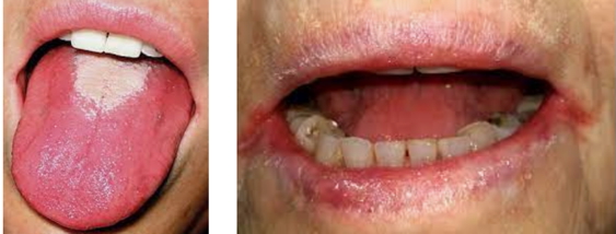 the haematological examination: Glossitis & Angular Stomatitis