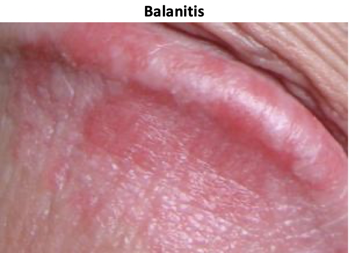 Balanitis