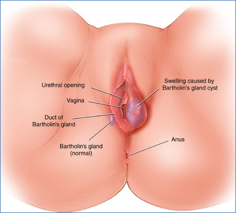 BARTHOLIN GLAND CYST
