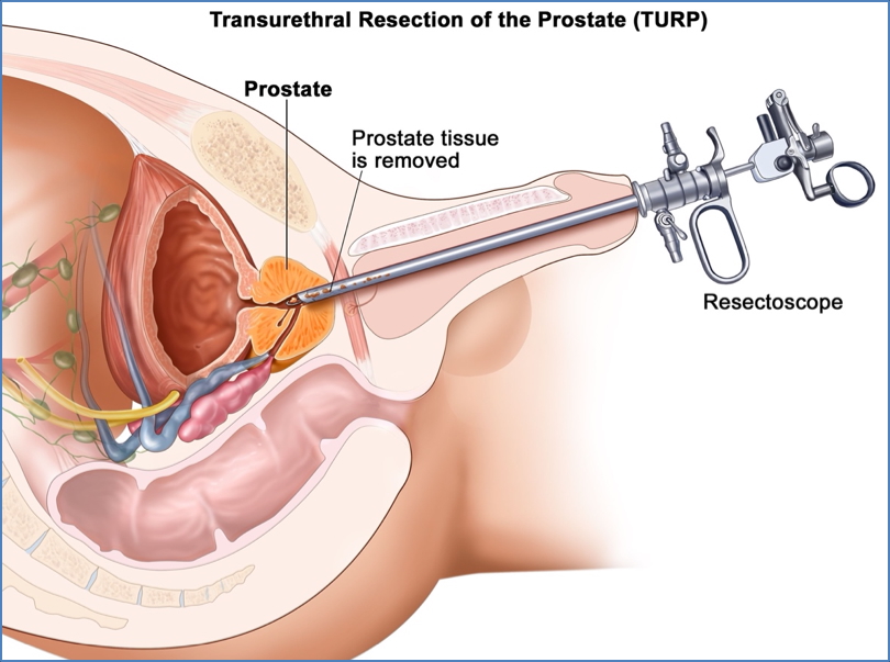 BPH – (BENIGN PROSTATIC HYPERTROPHY
