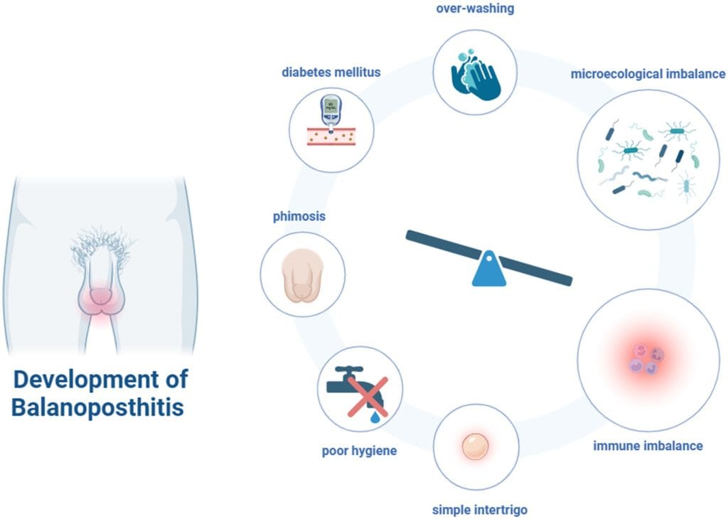 Balanitis balanoposthitis causes