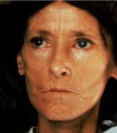 the rheumatological examination: Bird-like Facies (Scleroderma)