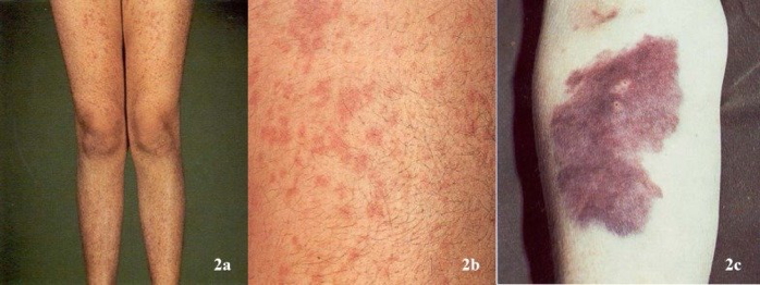 the haematological examination: Bruising, Petechiae, Purpura