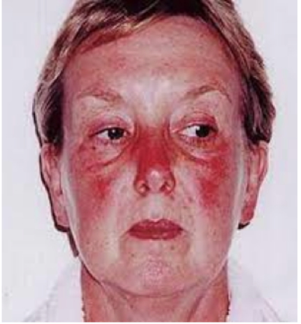 the rheumatological examination: Butterfly Rash & Hair Loss