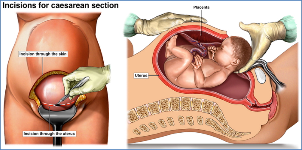operative obstetrics: CAESAREAN DELIVERY
